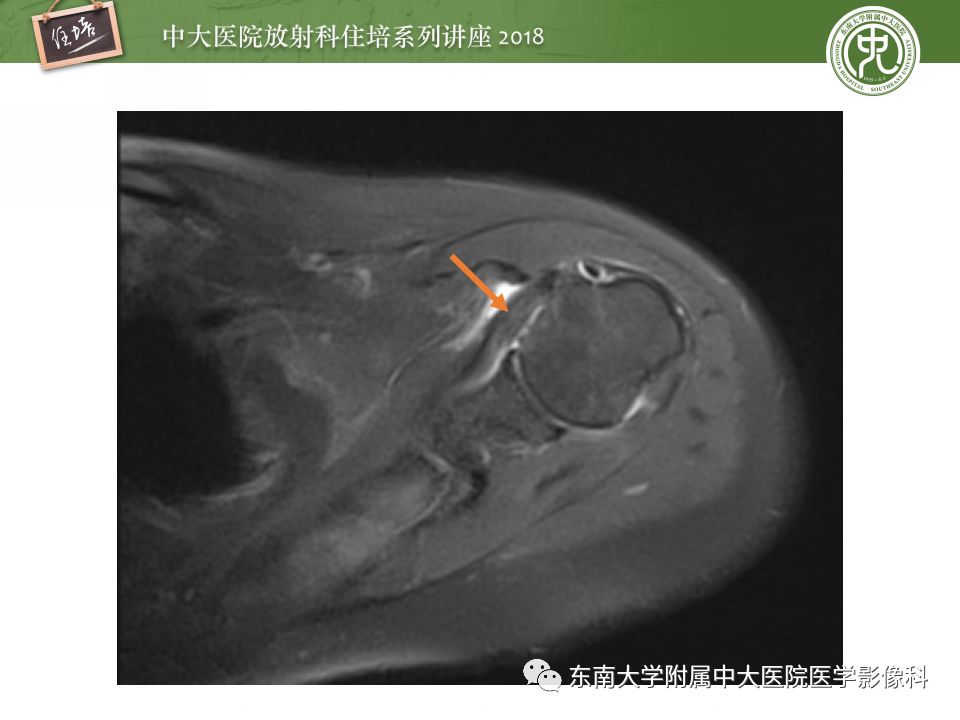 【PPT】肩关节病变影像诊断分析