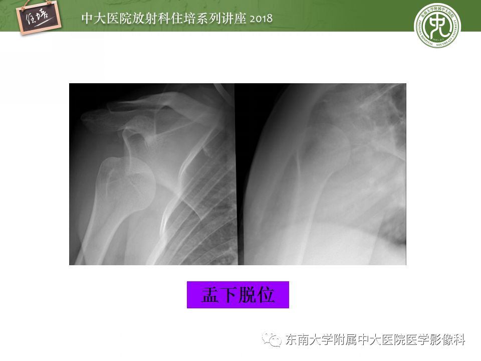 【PPT】肩关节病变影像诊断分析