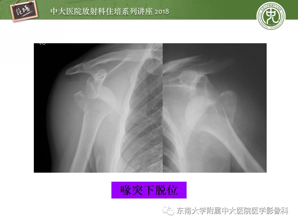 【PPT】肩关节病变影像诊断分析