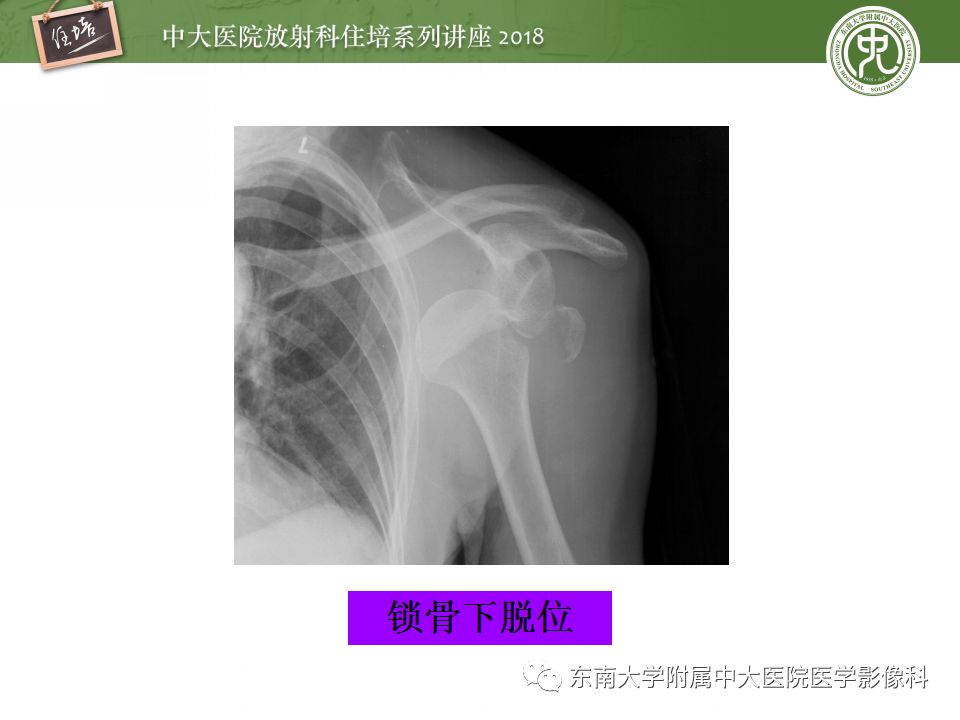 【PPT】肩关节病变影像诊断分析