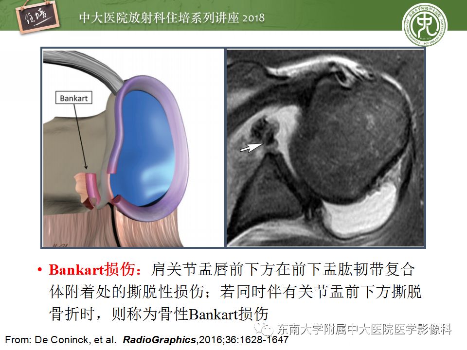 【PPT】肩关节病变影像诊断分析