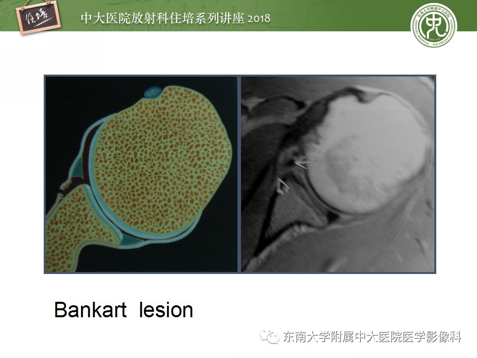 【PPT】肩关节病变影像诊断分析