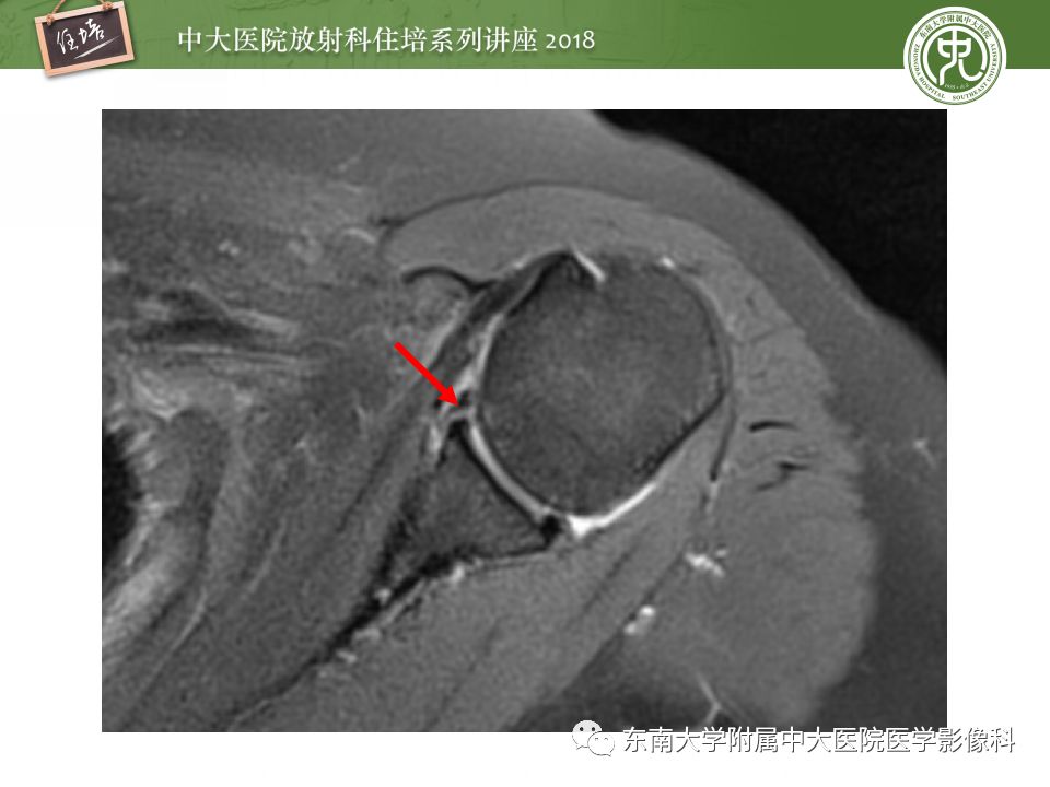 【PPT】肩关节病变影像诊断分析