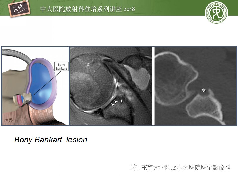 【PPT】肩关节病变影像诊断分析