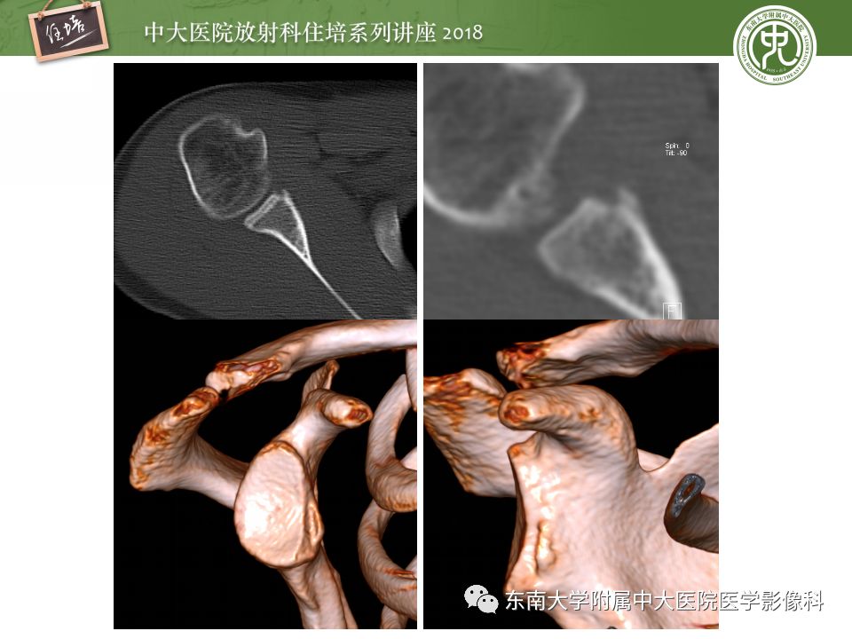 【PPT】肩关节病变影像诊断分析