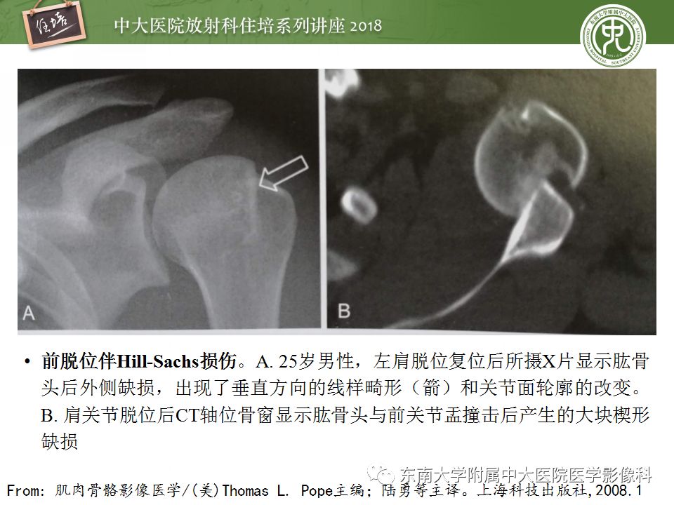 【PPT】肩关节病变影像诊断分析