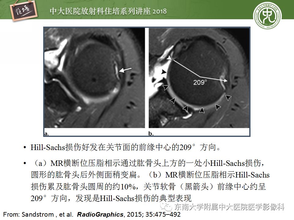 【PPT】肩关节病变影像诊断分析