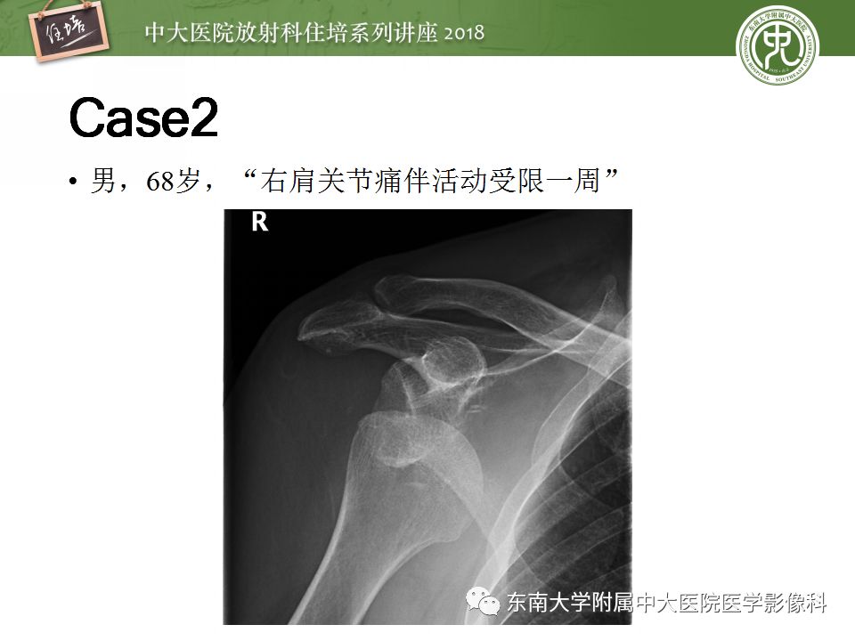 【PPT】肩关节病变影像诊断分析