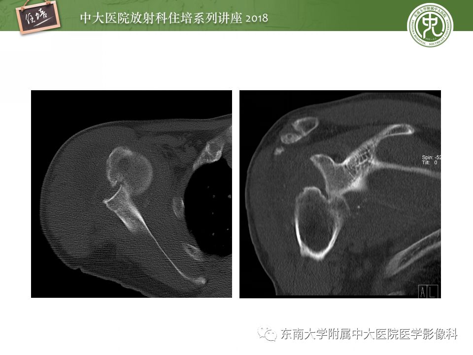 【PPT】肩关节病变影像诊断分析
