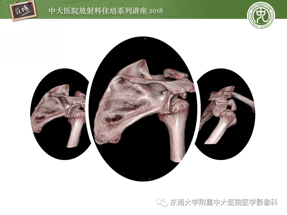 【PPT】肩关节病变影像诊断分析