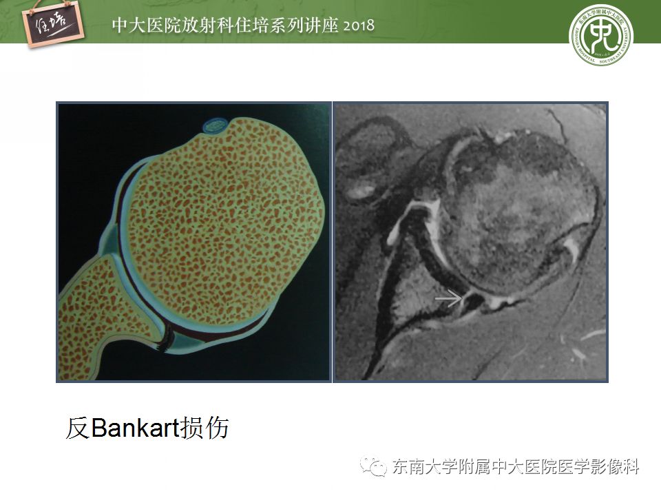 【PPT】肩关节病变影像诊断分析