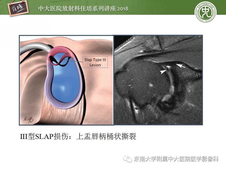 【PPT】肩关节病变影像诊断分析