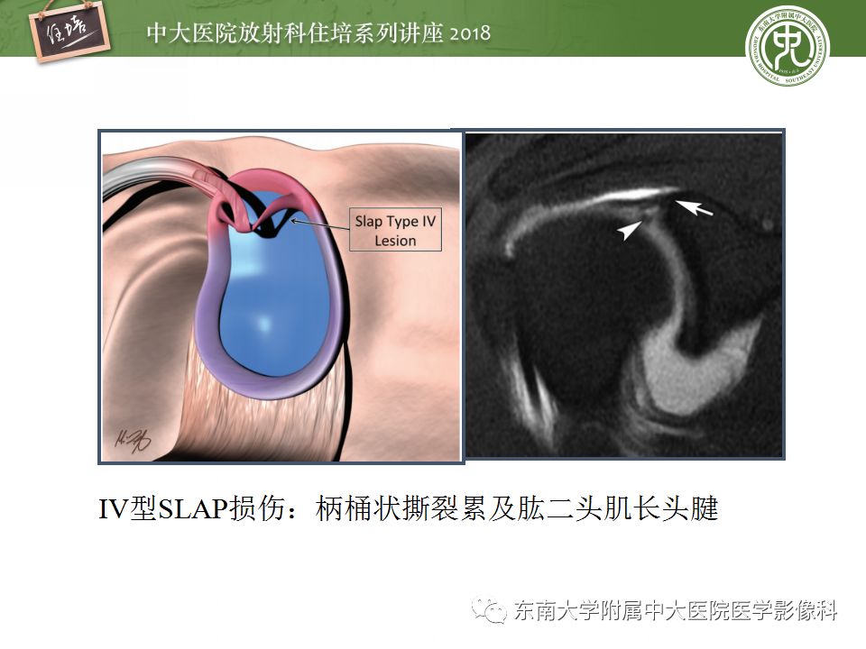 【PPT】肩关节病变影像诊断分析