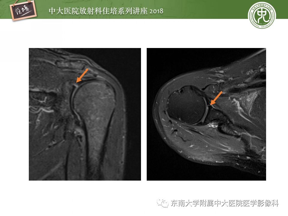 【PPT】肩关节病变影像诊断分析