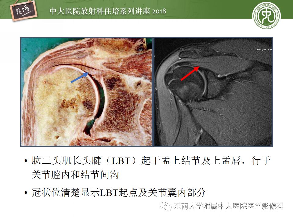 【PPT】肩关节病变影像诊断分析