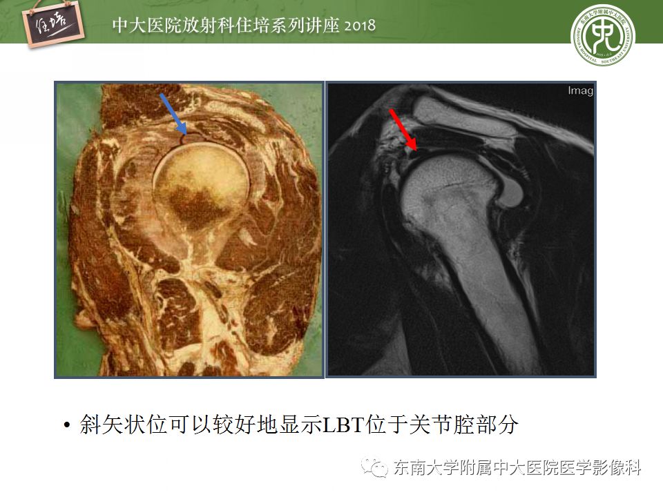 【PPT】肩关节病变影像诊断分析