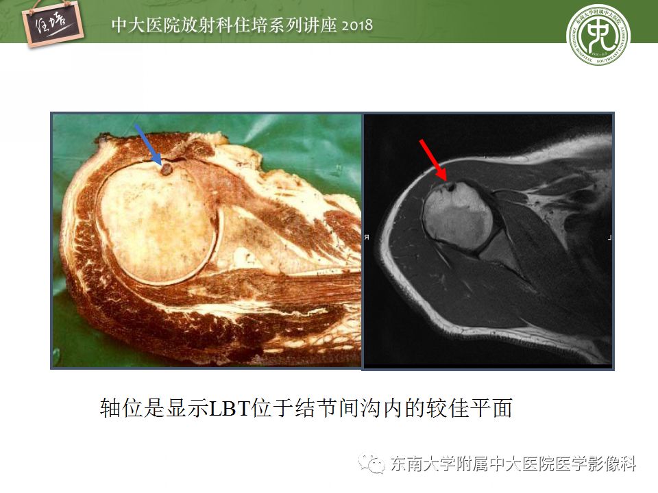 【PPT】肩关节病变影像诊断分析