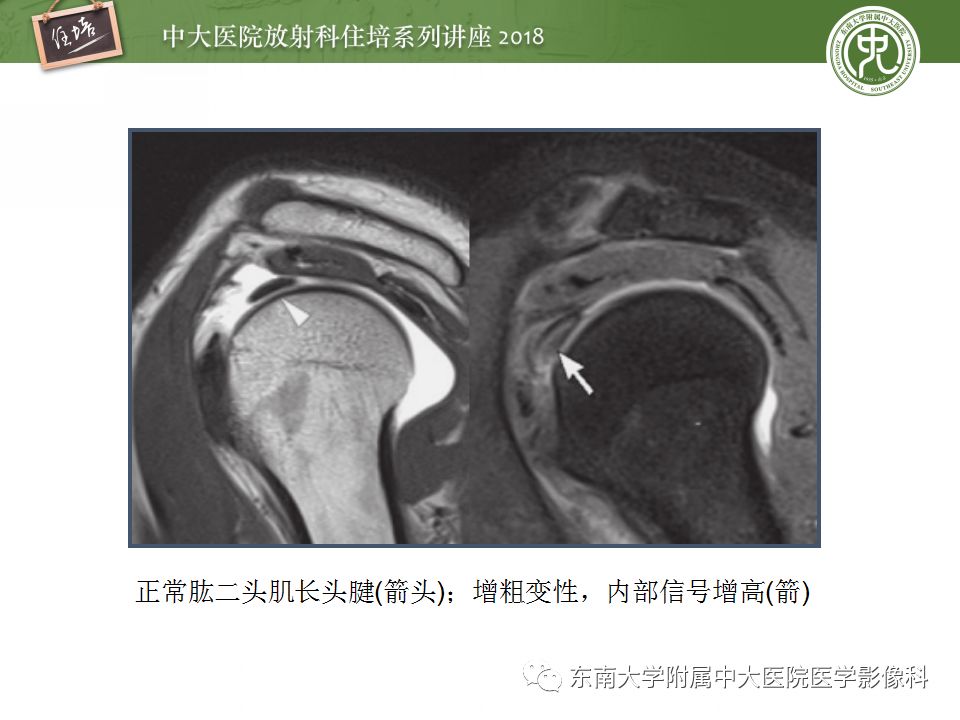 【PPT】肩关节病变影像诊断分析