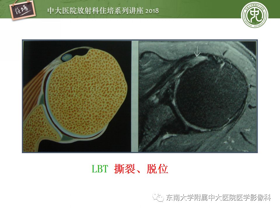 【PPT】肩关节病变影像诊断分析