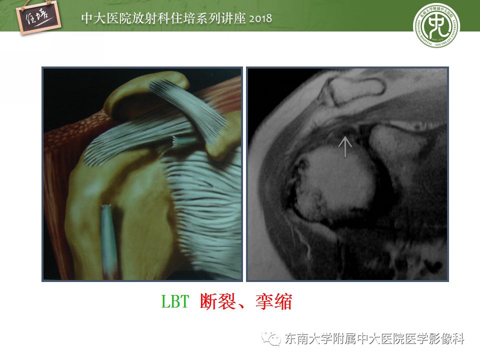 【PPT】肩关节病变影像诊断分析