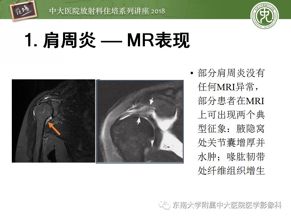 【PPT】肩关节病变影像诊断分析