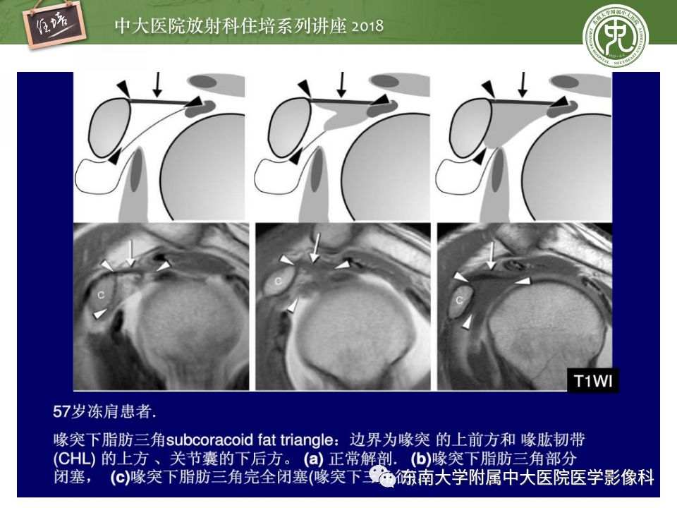 【PPT】肩关节病变影像诊断分析