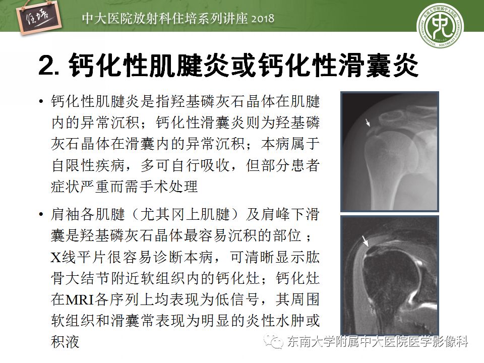 【PPT】肩关节病变影像诊断分析