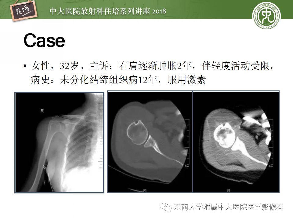 【PPT】肩关节病变影像诊断分析