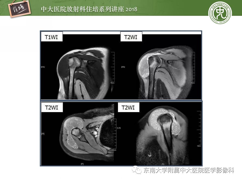 【PPT】肩关节病变影像诊断分析