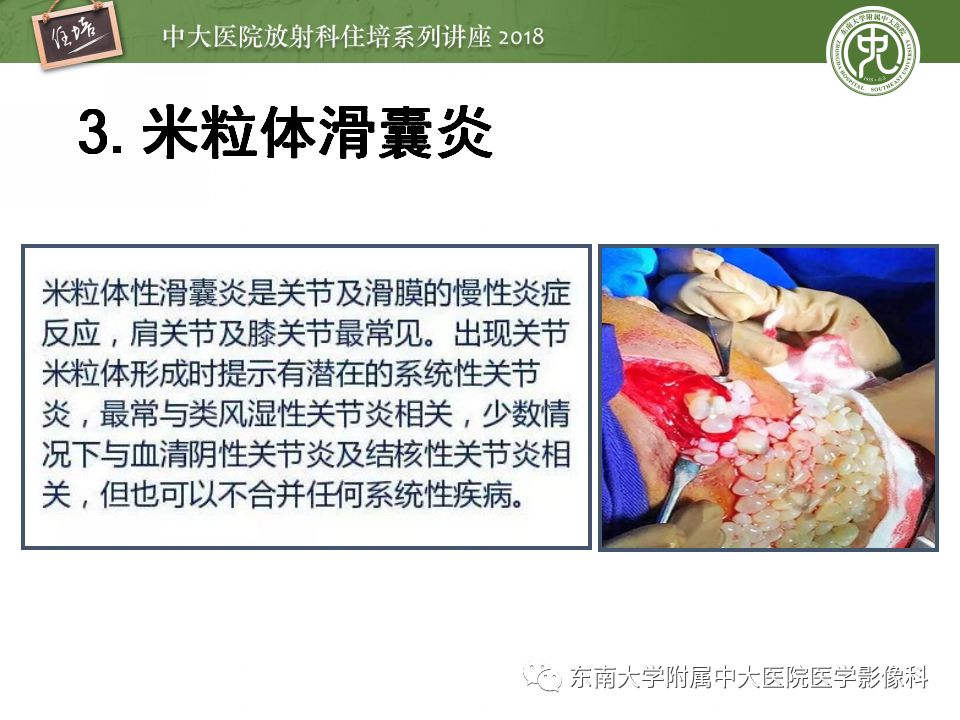 【PPT】肩关节病变影像诊断分析