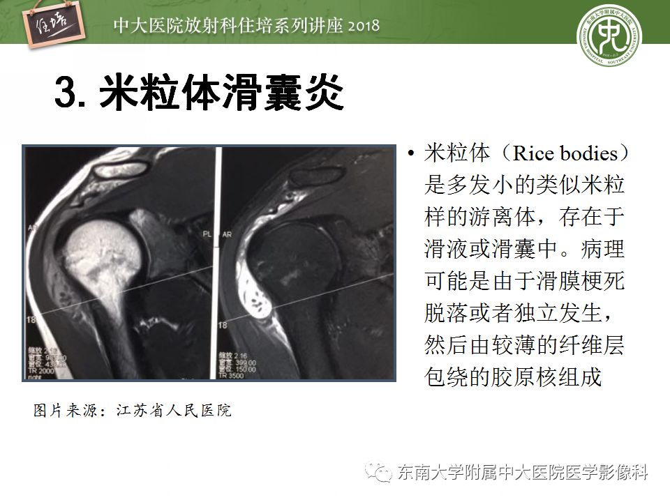 【PPT】肩关节病变影像诊断分析