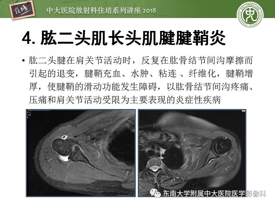 【PPT】肩关节病变影像诊断分析