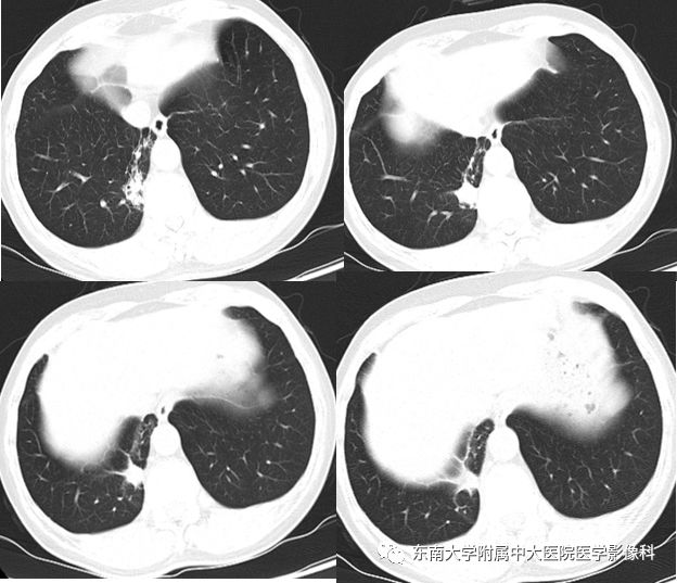 【病例】肺动静脉畸形1例CT影像