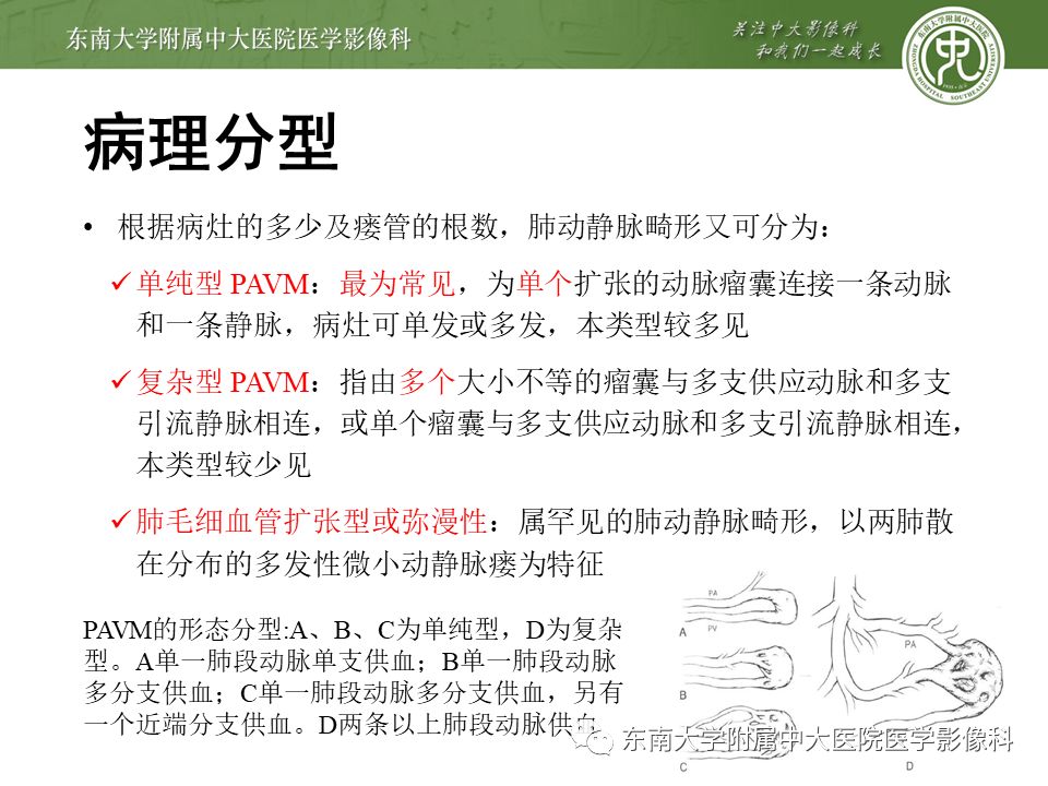【病例】肺动静脉畸形1例CT影像