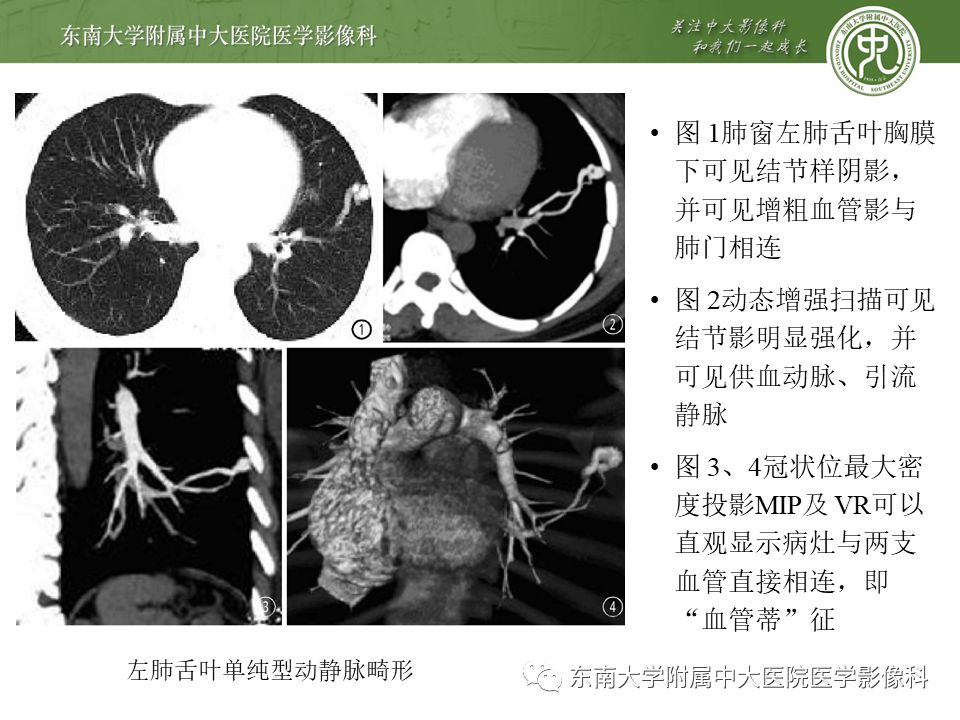 【病例】肺动静脉畸形1例CT影像