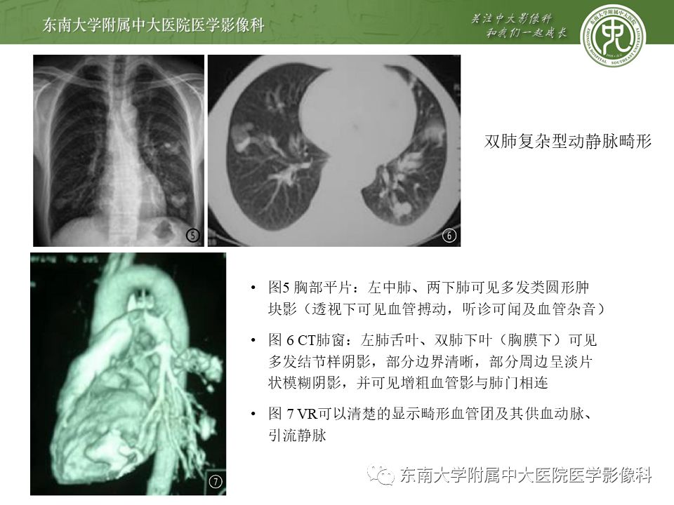 【病例】肺动静脉畸形1例CT影像