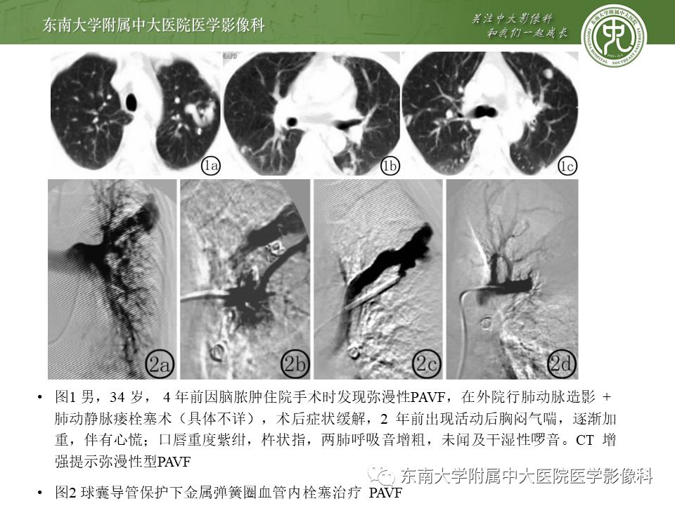 【病例】肺动静脉畸形1例CT影像