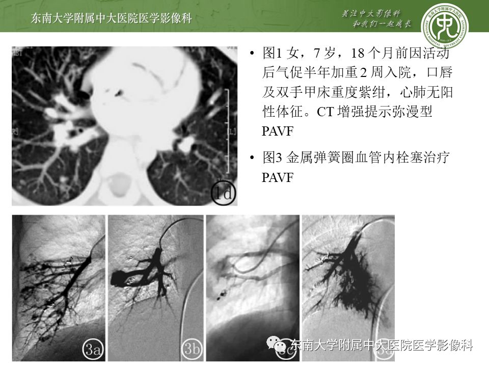 【病例】肺动静脉畸形1例CT影像