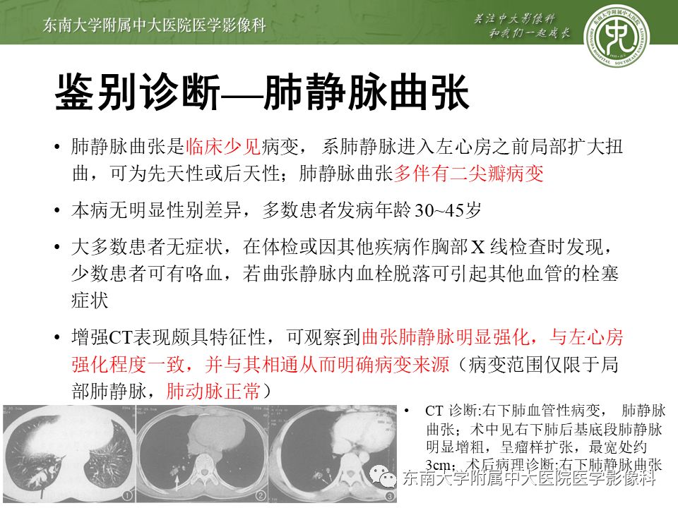 【病例】肺动静脉畸形1例CT影像