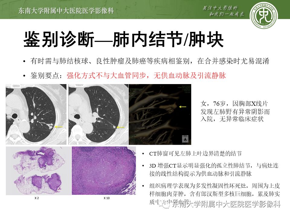 【病例】肺动静脉畸形1例CT影像
