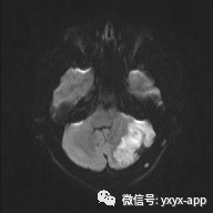 【病例】后颅窝表皮样囊肿1例MR 【病例】后颅窝表皮样囊肿1例MR