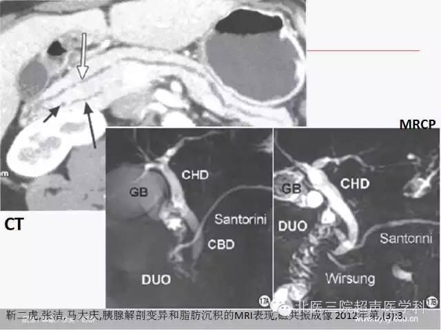 【PPT】胰腺常见解剖变异及影像学表现