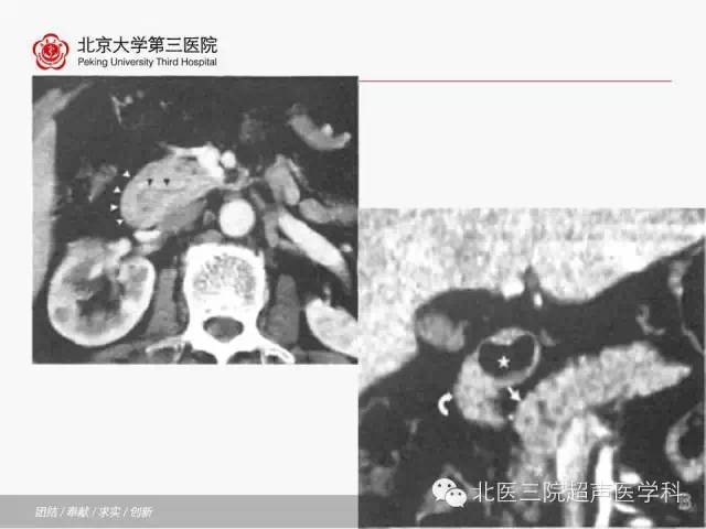 【PPT】胰腺常见解剖变异及影像学表现