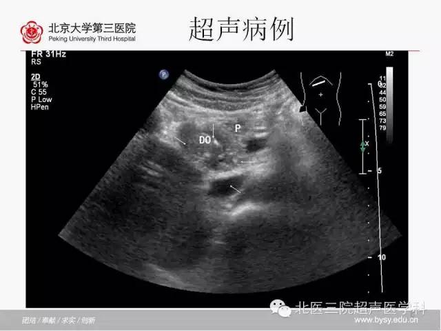 【PPT】胰腺常见解剖变异及影像学表现