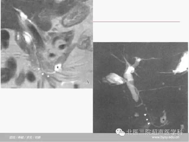 【PPT】胰腺常见解剖变异及影像学表现