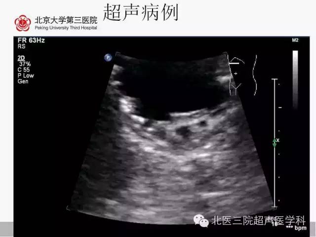 【PPT】胰腺常见解剖变异及影像学表现