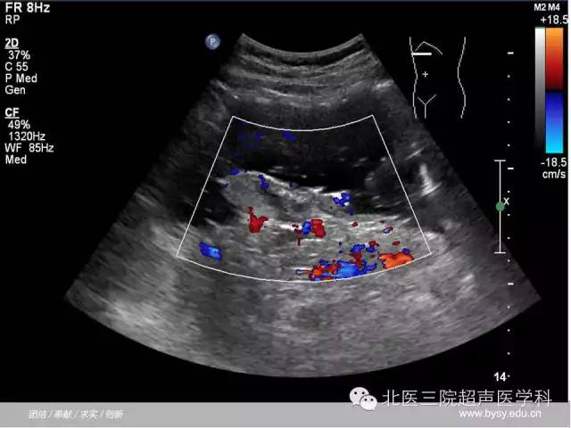 【PPT】胰腺常见解剖变异及影像学表现