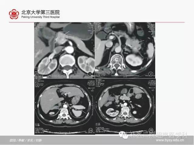 【PPT】胰腺常见解剖变异及影像学表现