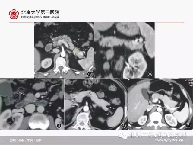 【PPT】胰腺常见解剖变异及影像学表现