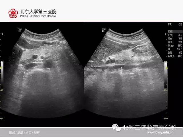 【PPT】胰腺常见解剖变异及影像学表现